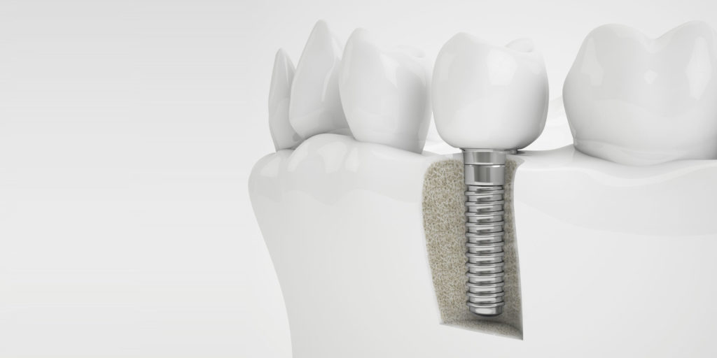 bone grafting model