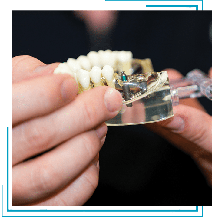 dental implant model