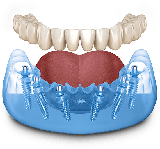 dental implants model
